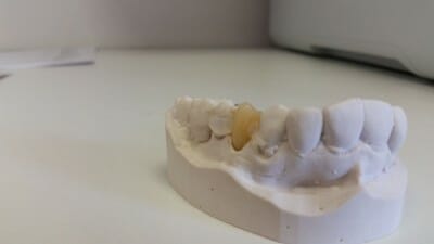 Clear Clasps | Natural Look Dentures | The Natural Denture Clinic