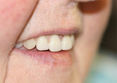 Premium Dentures